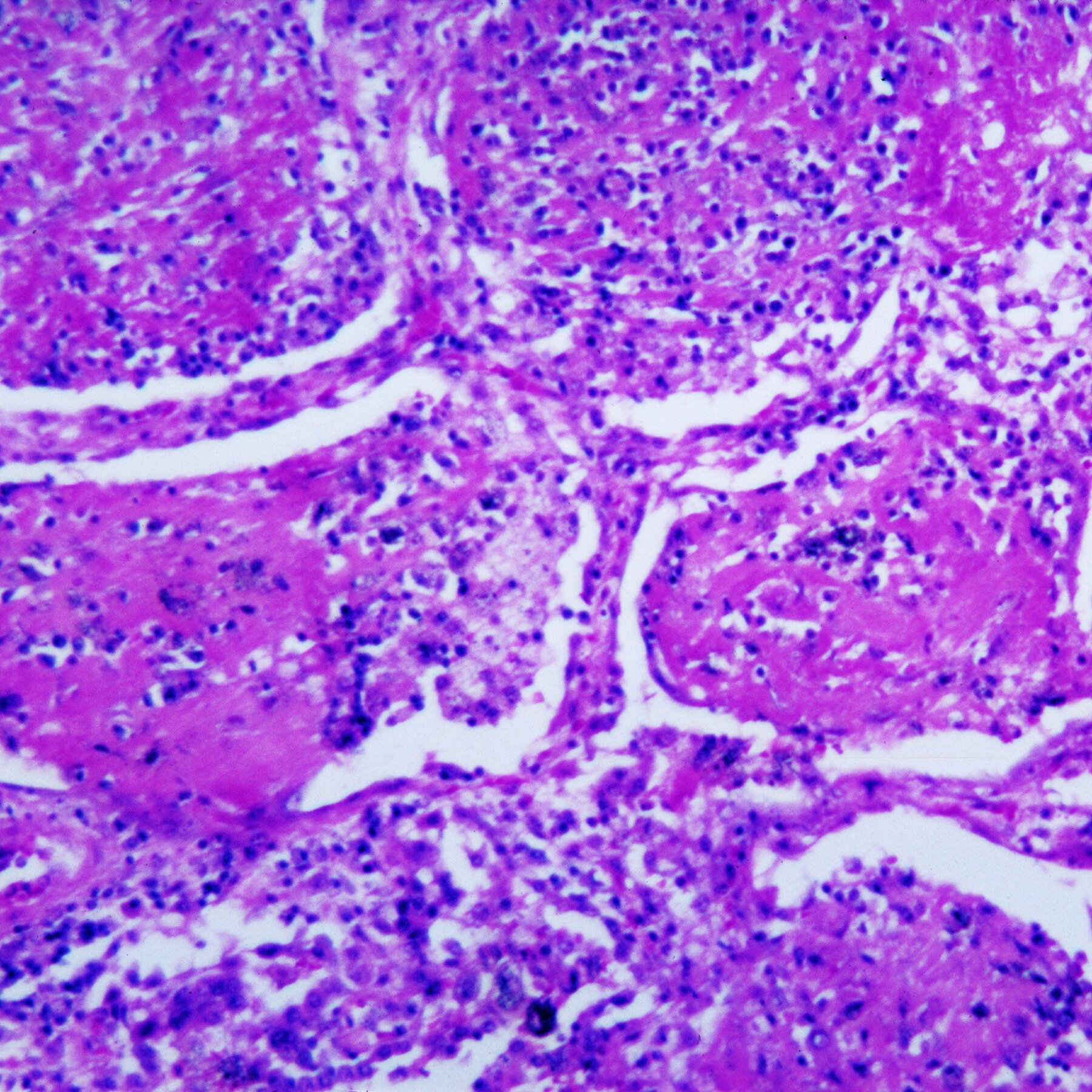 Dozens Are Sickened by a Rare Fungal Infection in Tennessee