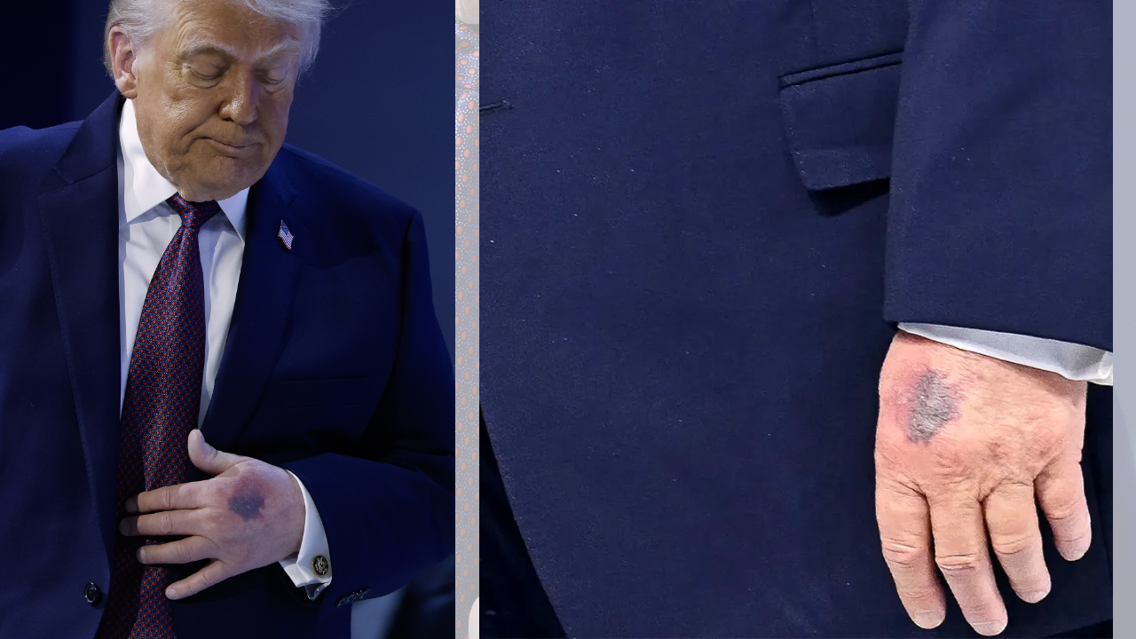 Row over Trump’s hand bruise in Davos and ‘missing medical records’: ‘Two years of Biden’s health…’